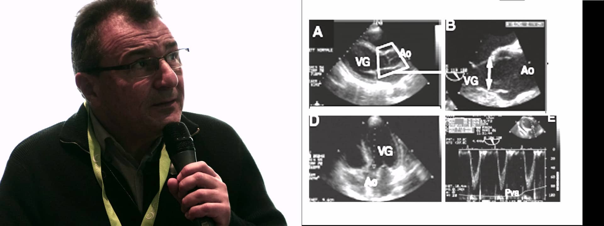 Left ventricle