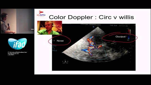 Transcranial Doppler