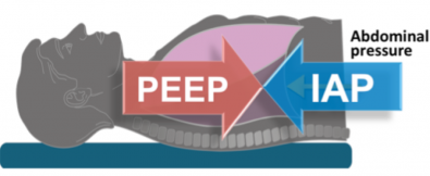 How to set PEEP in Abdominal Hypertension